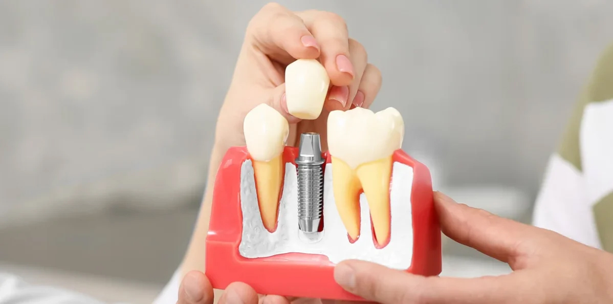Dental-Implants