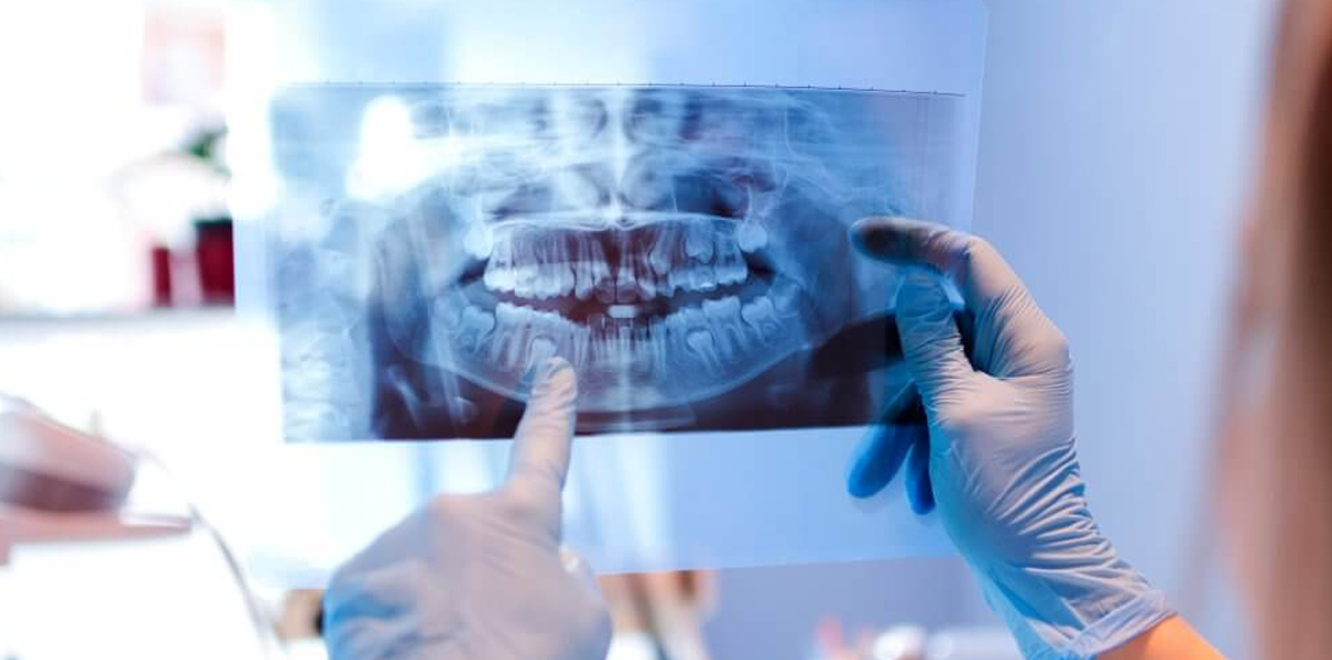 Digital-Dental-X-Ray