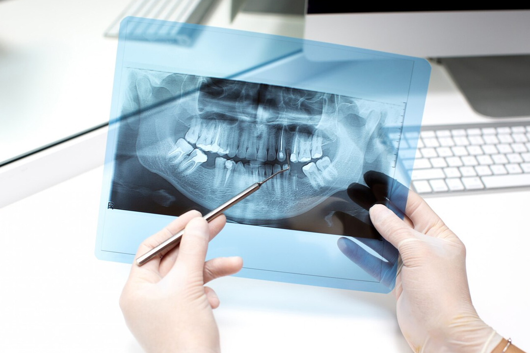 Digital-Dental-X-Ray