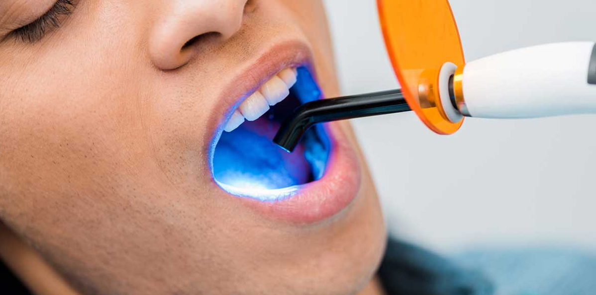 Light-Cure-Filling