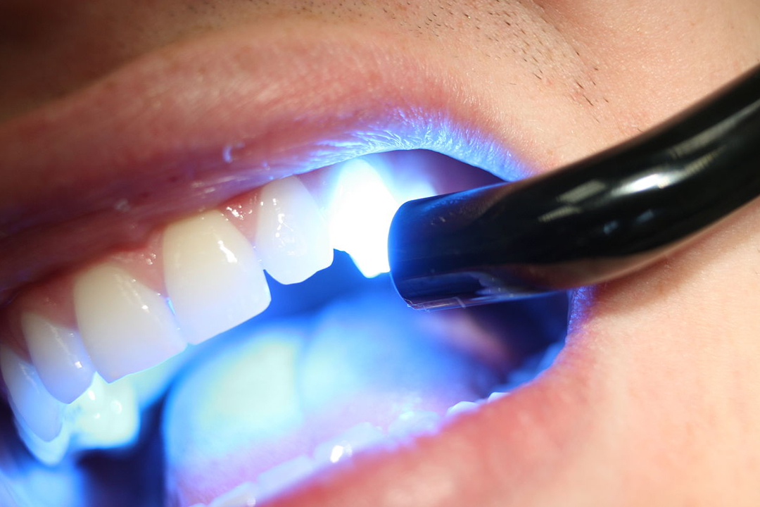 Light-Cured-Fillings