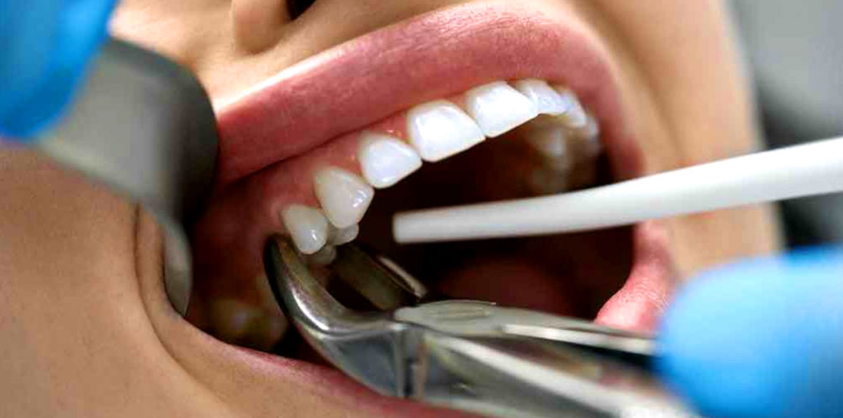 Painless-Extractions