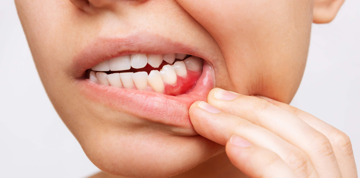 Pyorrhoea-&-Gums-Treatment