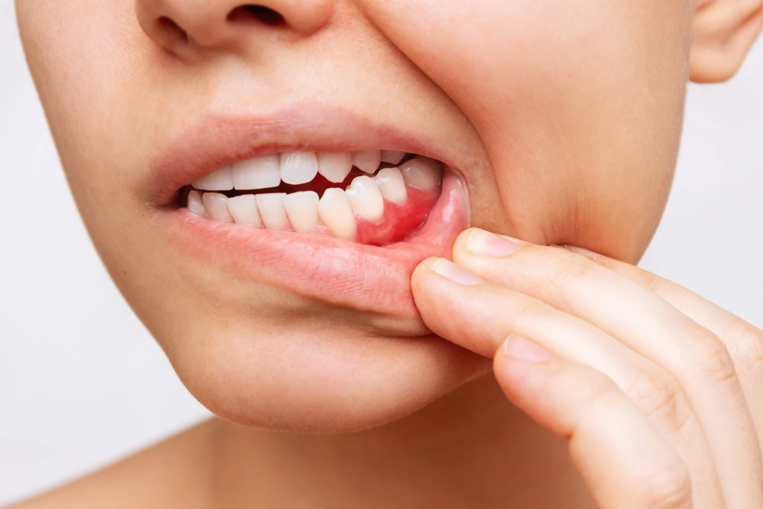 Pyorrhoea-&-Gums-Treatment