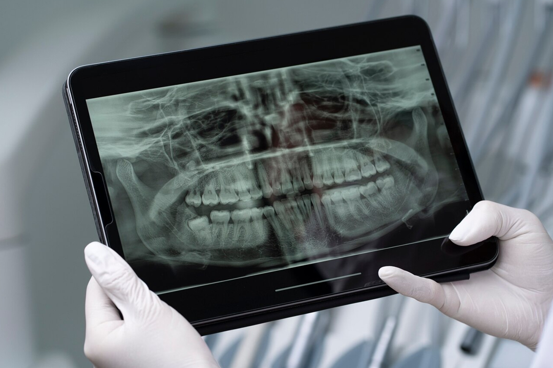 Root Canal With Digital Tech