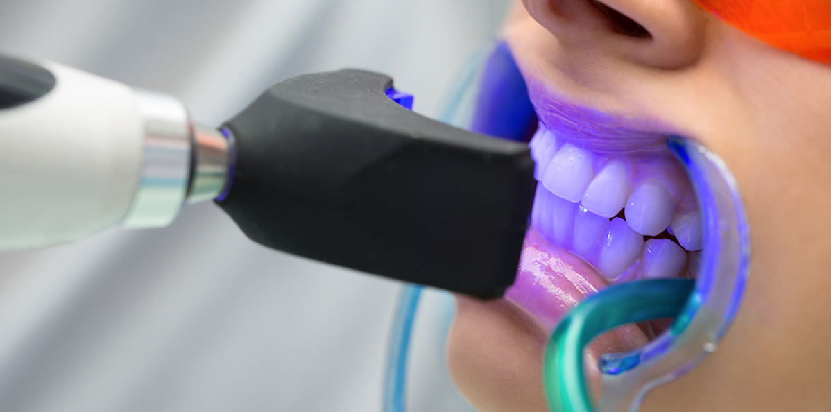 Tooth-Bleaching