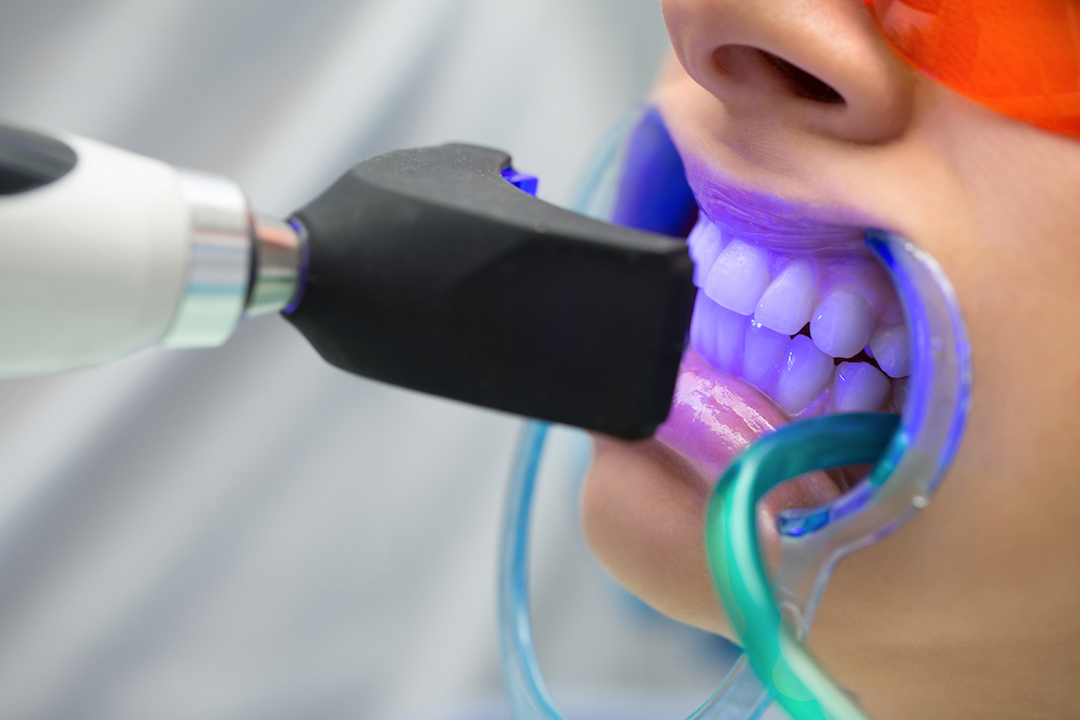 Tooth-Bleaching