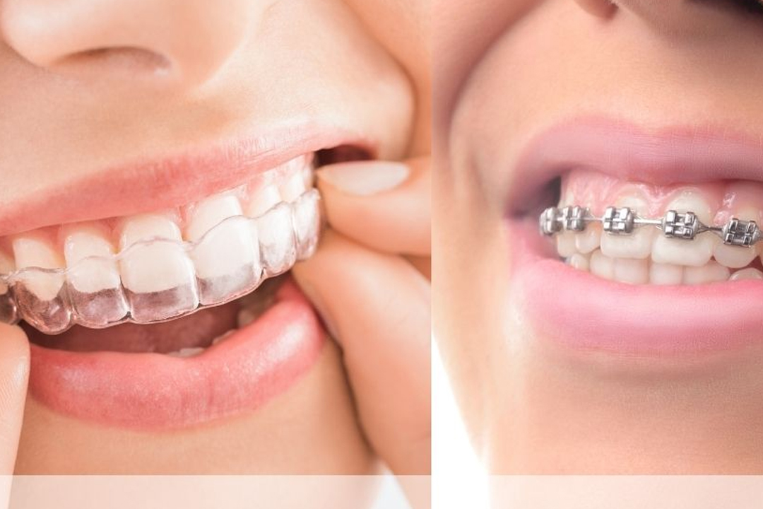 Treatment-for-irregular-teeth