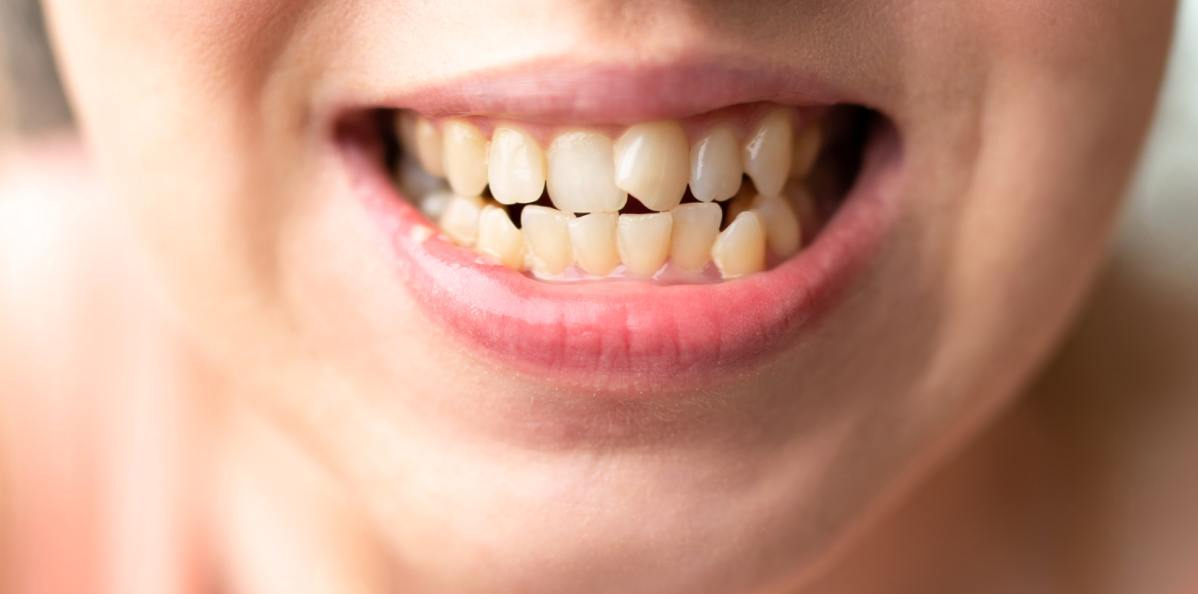 Treatment-irregular-teeth