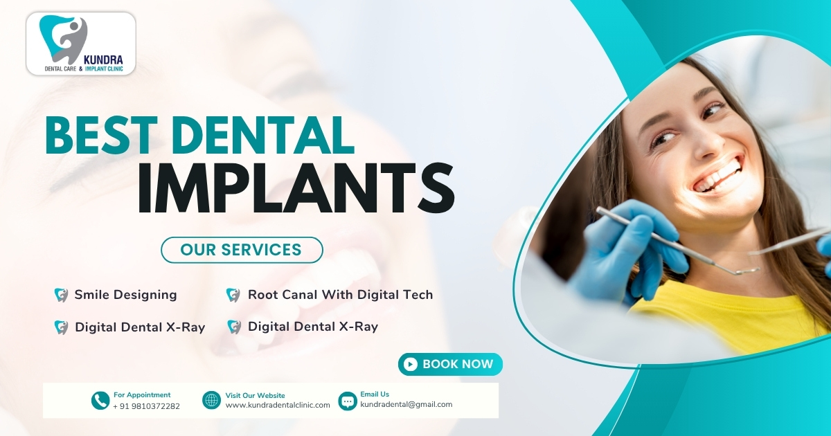 Partial Dental Implants: A Modern Solution for Missing Teeth at Kundra Dental Clinic