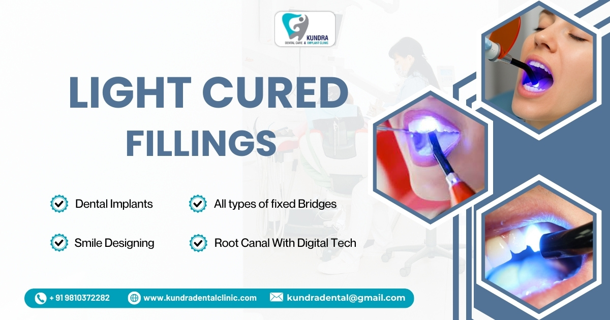 Discover the Power of Precision: Laser Cavity Filling Near Me – The Future of Pain-Free Dentistry in Delhi